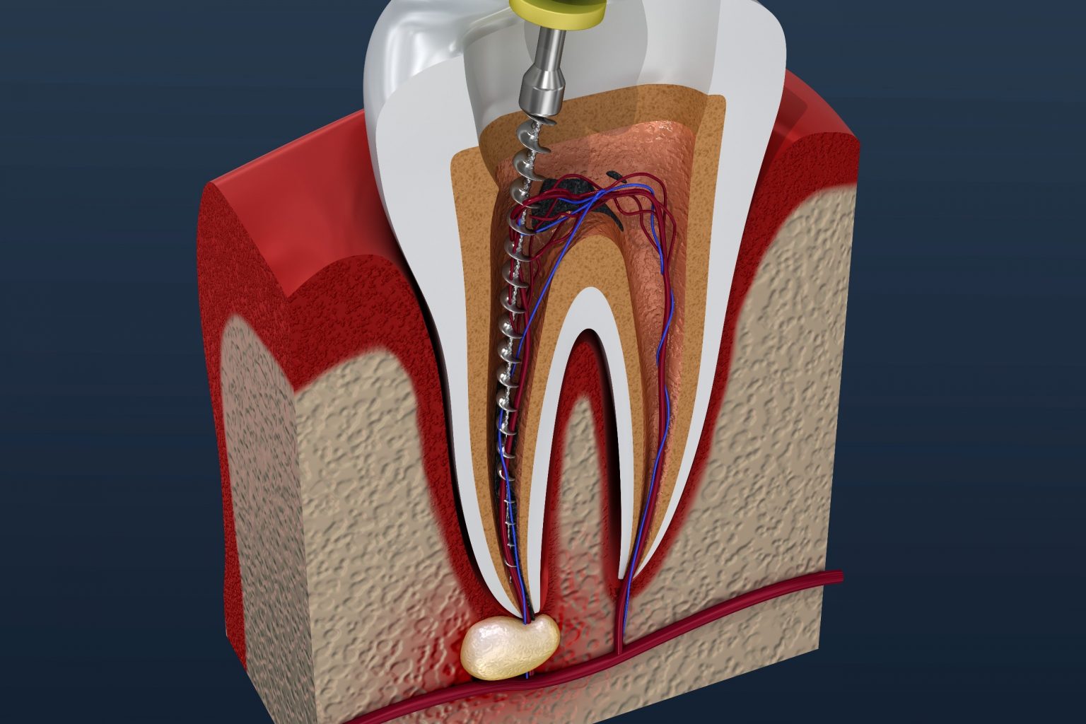 root-canal-1536x1024